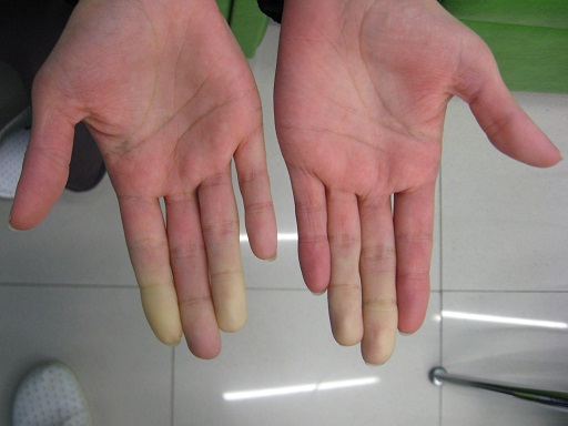 Condição que causa a diminuição do fluxo sanguíneo em determinadas partes do corpo