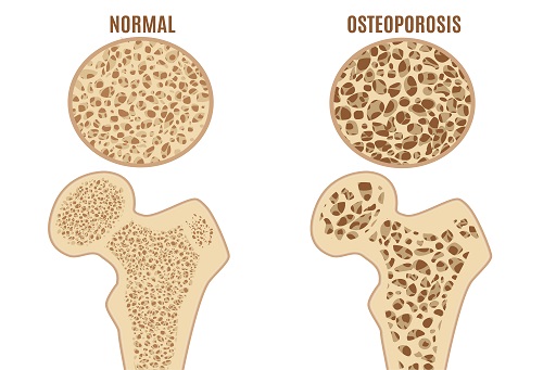 Doença crônica que enfraquece os ossos, tornando-os mais frágeis e suscetíveis a fraturas