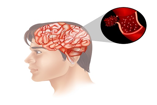 Já teve ou já lhe foi dito que pode vir a ter um acidente vascular cerebral (AVC)