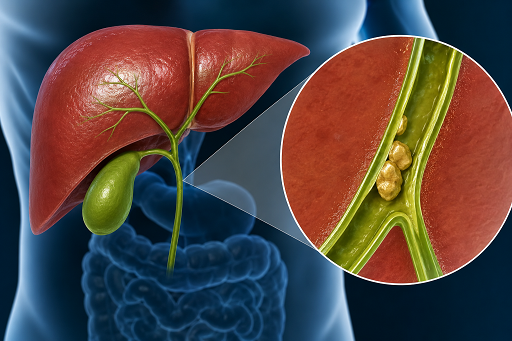 Condição em que o fluxo da bile do fígado para o intestino é reduzido ou totalmente interrompido
