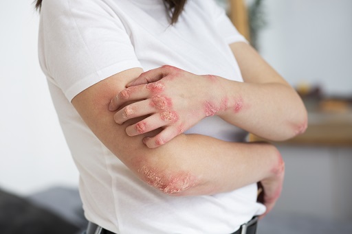 Infecção de pele, unhas ou cabelos causada pelo crescimento descontrolado de fungos