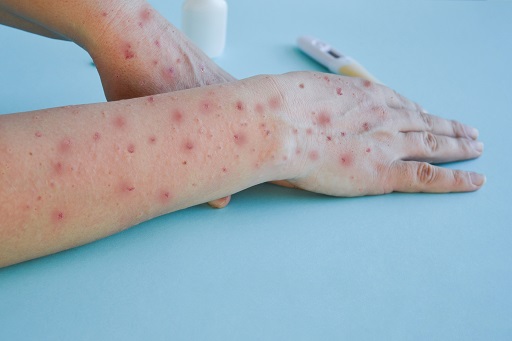 Manifestações clínicas, geralmente na pele ou mucosas, causadas pela infecção da bactéria Treponema pallidum