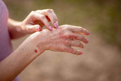 Alterações intensas na pele, como manchas vermelhas, bolhas ou descamação, geralmente causadas por inflamação, reação alérgica severa ou infecção