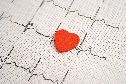 Arritmia cardíaca grave, geralmente genética, caracterizada pelo tempo de recuperação anormalmente prolongado do coração entre os batimentos