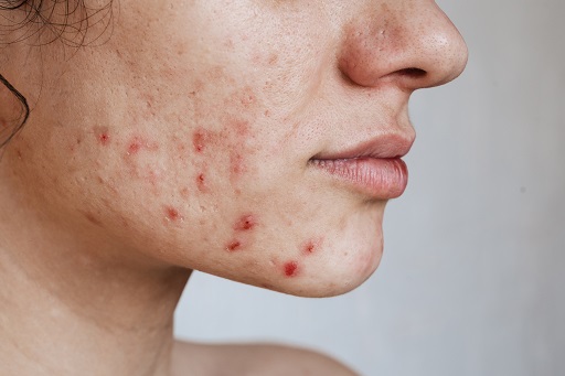 Acne em pacientes com doença de crohn