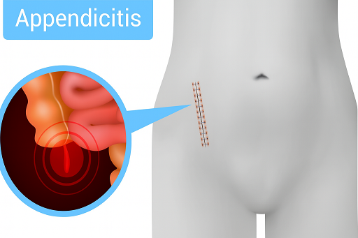 Apendicite