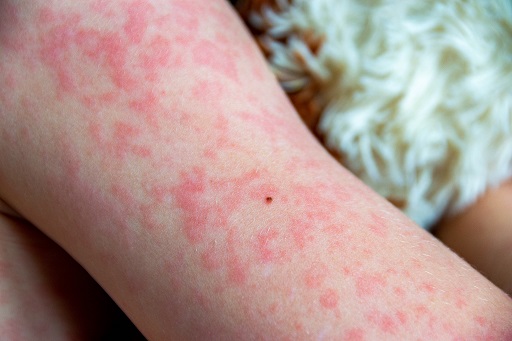 Dermatose neutrofílica febril aguda