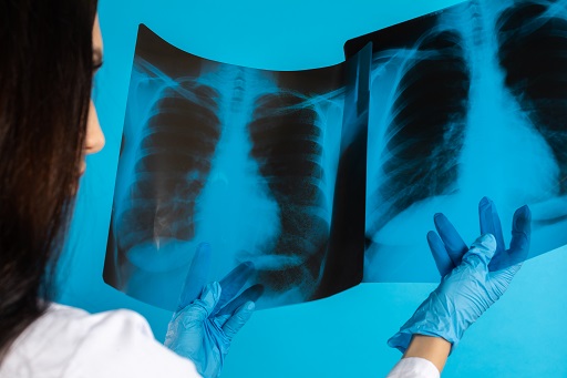Derrame pleural