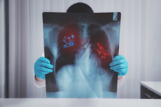 Doença pulmonar infiltrativa difusa aguda
