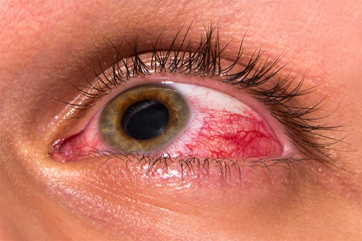 Herpes oftálmica