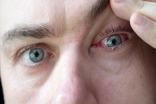 Infecção e irritação conjuntiva