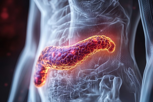 Pancreatite Aguda