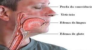 Choque Anafilático