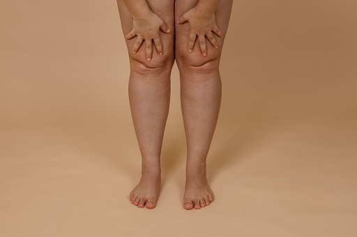 Edema
