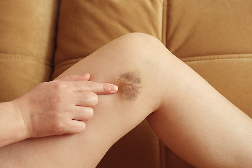 Hematoma local