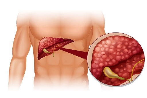 Hepatite Medicamentosa