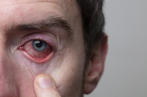Hiperemia Ocular