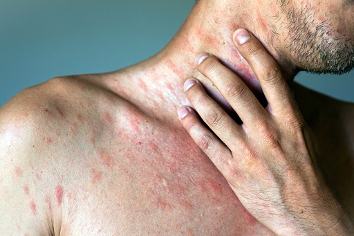 Síndrome de Stevens-Johnson