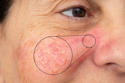 Síndrome lupus-like